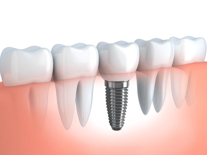 Dental Implants  Marathon, FL 